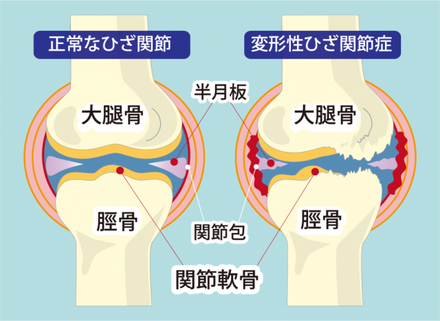 変形性膝関節症改善に際し、大切にしていること