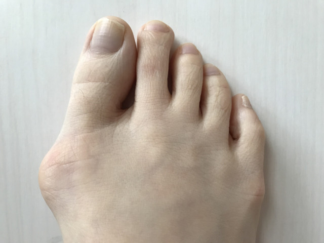 外反母趾改善に際して大切にしていること